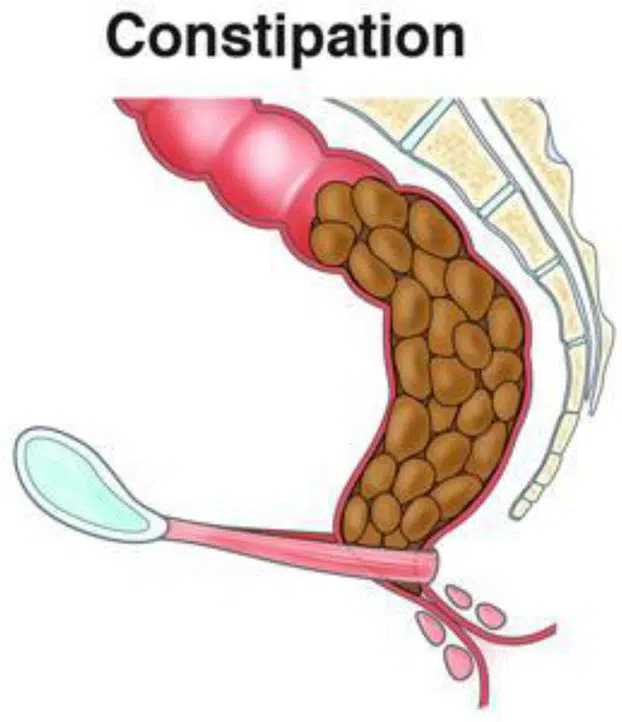 Ilustrasi Konstipasi